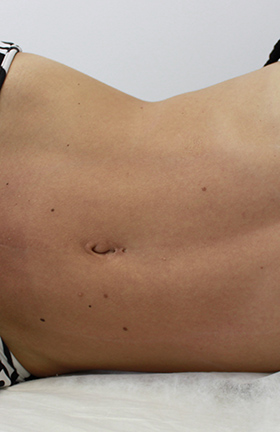 abdominoplastia