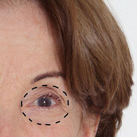 blefaroplastia